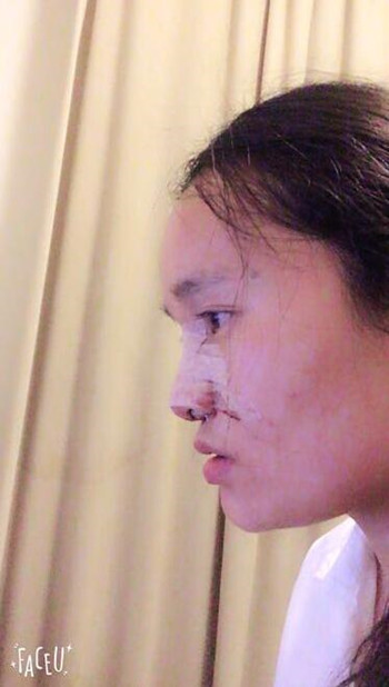 做了隆鼻整形手術(shù)整個(gè)鼻子靈巧了許多 快來(lái)圍觀果