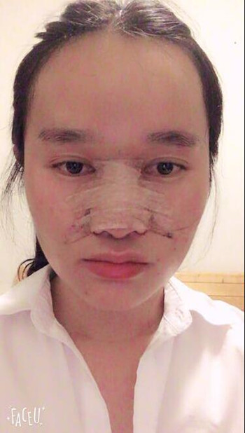 做了隆鼻整形手術(shù)整個(gè)鼻子靈巧了許多 快來(lái)圍觀果