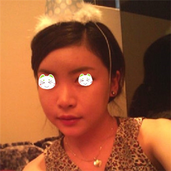 分享美立方做下頜角整形手術(shù)經(jīng)歷，還有前后對(duì)比果圖片哦~