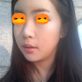 分享美立方做下頜角整形手術(shù)經(jīng)歷，還有前后對(duì)比果圖片哦~