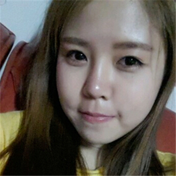 藝星做的玻尿酸去法令紋，分享恢復(fù)過程和前后對比照片~