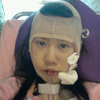 磨下頜角面部輪廓整形上個月，分享恢復(fù)過程和對比照片哦~