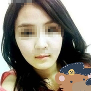 南相宰磨下頜角手術(shù)恢復(fù)過程分享，還有前后對比圖片哦~