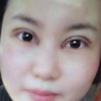 割雙眼皮和開內(nèi)眼角一起做了，護(hù)理了近一個月完全恢復(fù)自然