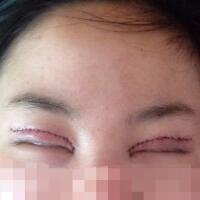 割雙眼皮和開內(nèi)眼角一起做了，護(hù)理了近一個月完全恢復(fù)自然