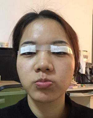 為了美麗大眼做了切開雙眼皮，果令我驚嘆
