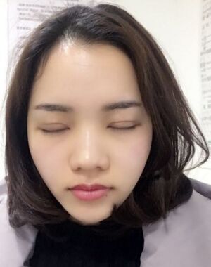 為了美麗大眼做了切開雙眼皮，果令我驚嘆