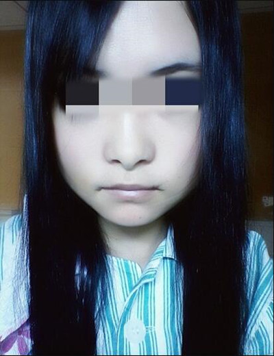 終于做了磨下頜角拯救了我的國字臉