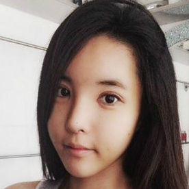 鷹鉤鼻矯正整形手術恢復過程和前后對比果圖片，分享給大家~