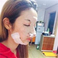 去年做的鷹鉤鼻矯正+面部脂肪填充，分享術后照片~