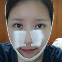 做了埋線雙眼皮、隆鼻、磨下頜角，兩個(gè)月了，分享恢復(fù)照片~