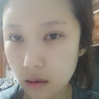 做了埋線雙眼皮、隆鼻、磨下頜角，兩個(gè)月了，分享恢復(fù)照片~