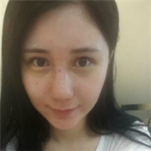 埋線雙眼皮+隆鼻手術(shù)恢復(fù)過(guò)程和前后對(duì)比果圖片真實(shí)分享~~~