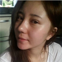 埋線雙眼皮+隆鼻手術(shù)恢復(fù)過(guò)程和前后對(duì)比果圖片真實(shí)分享~~~