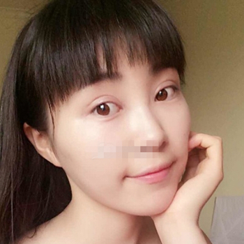 開外眼角手術一個月了，分享恢復過程和前后對比果照片~