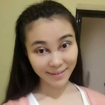 開外眼角手術一個月了，分享恢復過程和前后對比果照片~