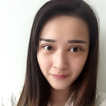 伊美馨做了開內眼角和雙眼皮手術，分享我的術后果照片~~