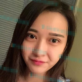 伊美馨做了開內眼角和雙眼皮手術，分享我的術后果照片~~