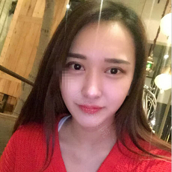 伊美馨做了開內眼角和雙眼皮手術，分享我的術后果照片~~