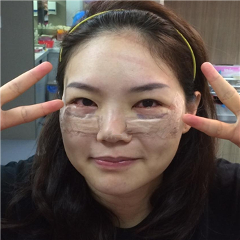 李阿姨眼袋失敗修復(fù)手術(shù)后的果圖，年輕了好幾歲~