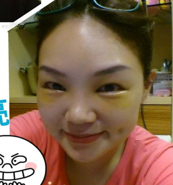 李阿姨眼袋失敗修復(fù)手術(shù)后的果圖，年輕了好幾歲~