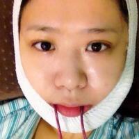 磨下頜角整形——恢復(fù)3個月后真實磨骨案例分享