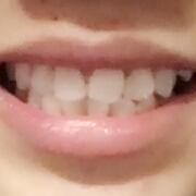 美容冠牙齒修復(fù)，緩解前后過程分享