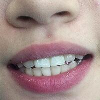 氧化鋯烤瓷牙價(jià)格5600元兩顆，果很滿意