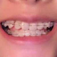 牙齒正畸矯正一年費用10000元