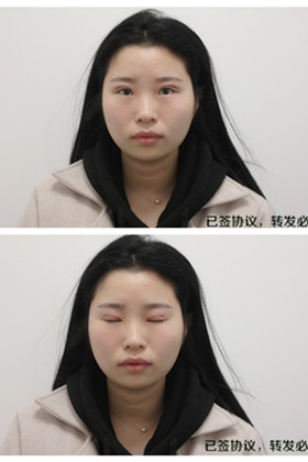剛做了雙眼皮切開重瞼手術，恢復得越來越自然了