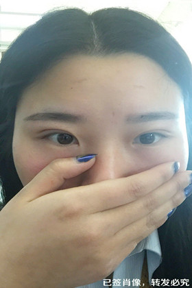 剛做了雙眼皮切開重瞼手術，恢復得越來越自然了