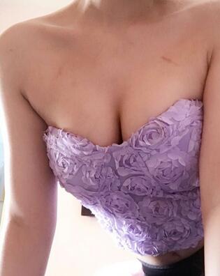 自體脂肪豐胸對(duì)比圖 抽脂隆胸十天