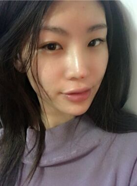 線D隆鼻恢復(fù)過(guò)程圖，看看我的果怎么樣