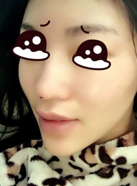 線D隆鼻恢復(fù)過(guò)程圖，看看我的果怎么樣