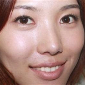 武漢希思特做了埋線法雙眼皮、開內(nèi)眼角和鼻尖移植軟骨整形手術(shù)~