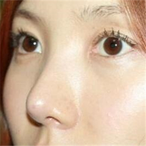 武漢希思特做了埋線法雙眼皮、開內(nèi)眼角和鼻尖移植軟骨整形手術(shù)~