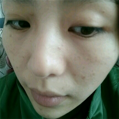 光子嫩膚和下巴脂肪填充術(shù)后果圖片分享，董萍門診做的~