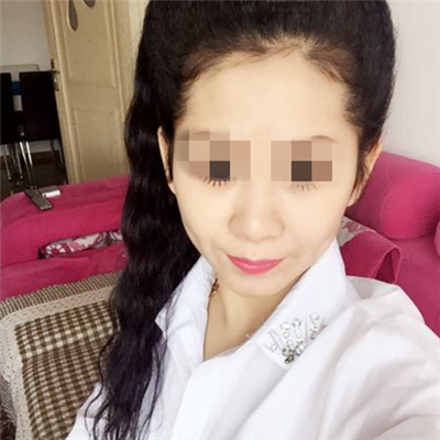 玻尿酸填充淚溝恢復(fù)過程和前后對(duì)比果圖片分享~