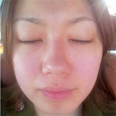 激光溶脂去眼袋恢復(fù)過程和前后對比果圖片分享哦~