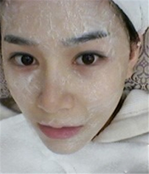 元旦做的光子嫩膚，分享恢復(fù)過(guò)程和前后對(duì)比果照片哦~