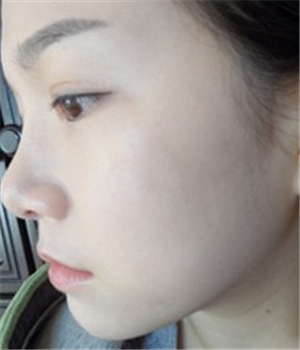 元旦做的光子嫩膚，分享恢復(fù)過(guò)程和前后對(duì)比果照片哦~