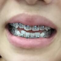 上海牙齒矯正過程分享，牙齒正畸8900元