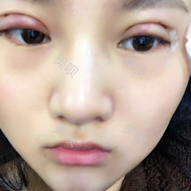 一個(gè)月時(shí)間的切開雙眼皮消腫過程圖分享