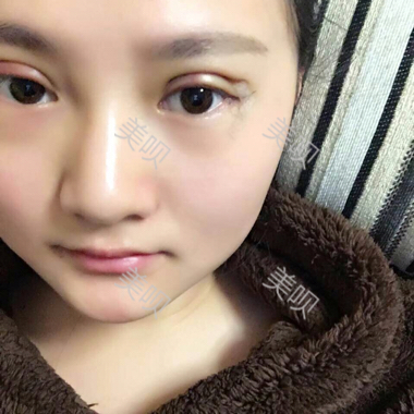 一個(gè)月時(shí)間的切開雙眼皮消腫過程圖分享