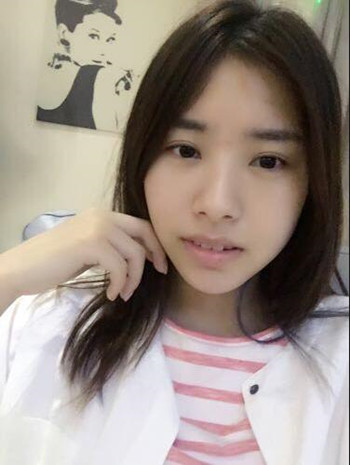 玻尿酸豐下巴果還不錯 過幾個月就做假體隆下巴