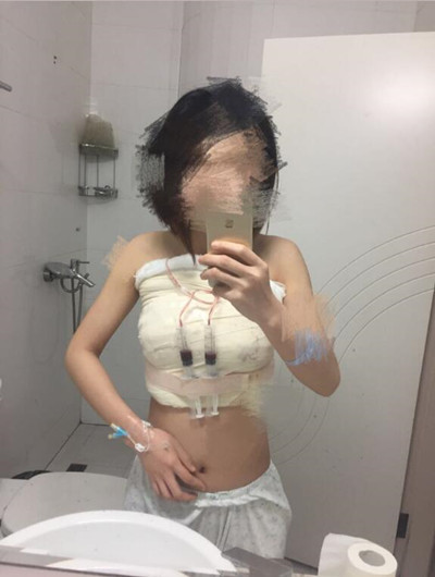 假體隆胸拯救了我的小平胸 快來(lái)看看我的果怎么樣