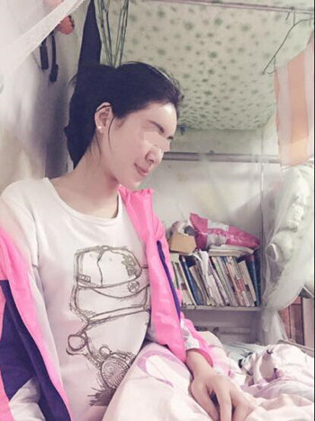 給大家分享一下我的自體脂肪填充全臉經(jīng)歷 內(nèi)有果對比圖