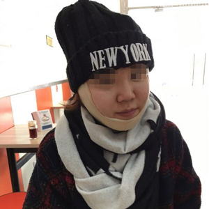 吸脂瘦臉手術(shù)半年了，分享前后對(duì)比果照片~