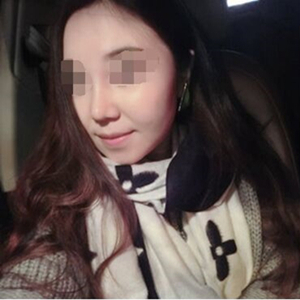 吸脂瘦臉手術(shù)半年了，分享前后對(duì)比果照片~