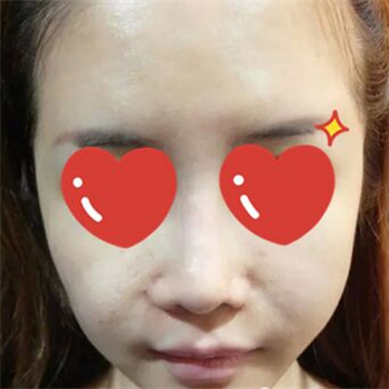 做音波拉皮除皺術(shù)一個月了，分享恢復(fù)過程和前后對比果圖片~